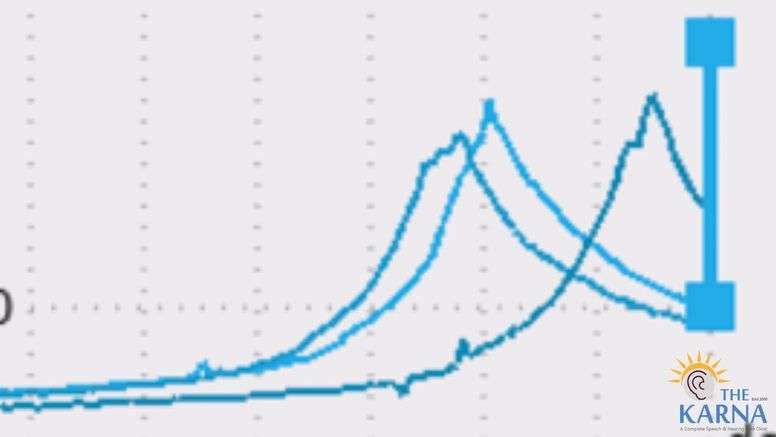 Eustachian Tube Function test assessing middle ear pressure regulation."