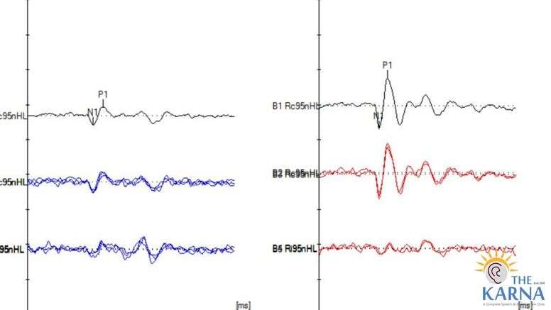 OVEMP test measuring vestibular (balance) function through muscle response.